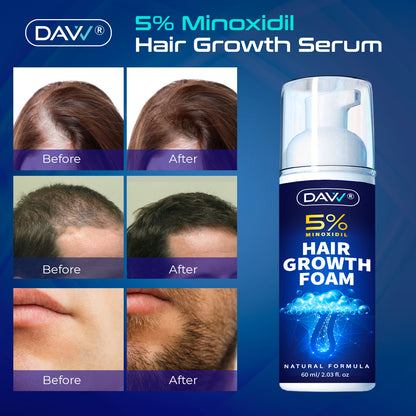 5% Minoxidil Hair Growth Foam For Men