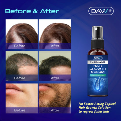 5% Minoxidil Hair Growth Serum For Men